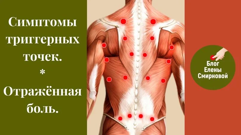 Карта триггерные точки фото Карта триггерных точек с отраженными болями: найдено 84 изображений