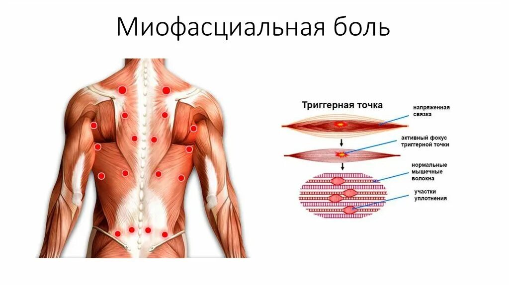 Карта триггерные точки фото Что такое миофасциальный болевой синдром: причины, симптомы, диагностика Многопр