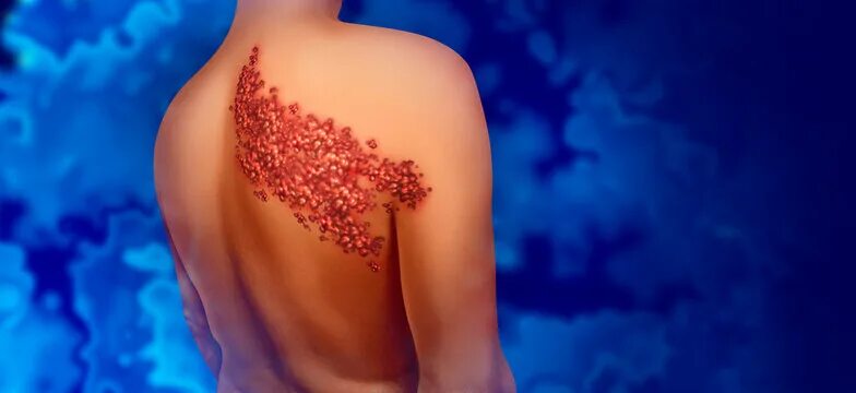 Картинки герпеса на теле человека фото Shingles Disease Зображення - огляд 13,527 Стокові фото, векторні зображення й в