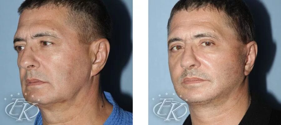 Костюшкин пластика лица до и после фото Пластика для мужчин - Пластический хирург Кудинова