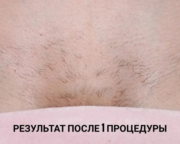 Красивые прически лобков фото Ksenija Permjakova Wanna get rid of extra hair ONCE AND FOREVER ❓ ❓ ❓ ❌ no ingro