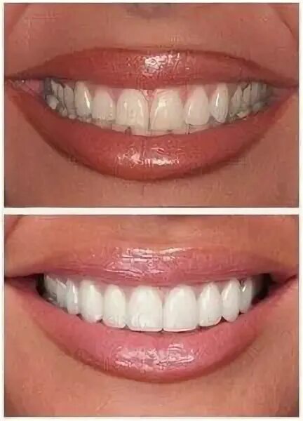 Красивые зубы фото женщины цирконий Pin on Our Dental Services
