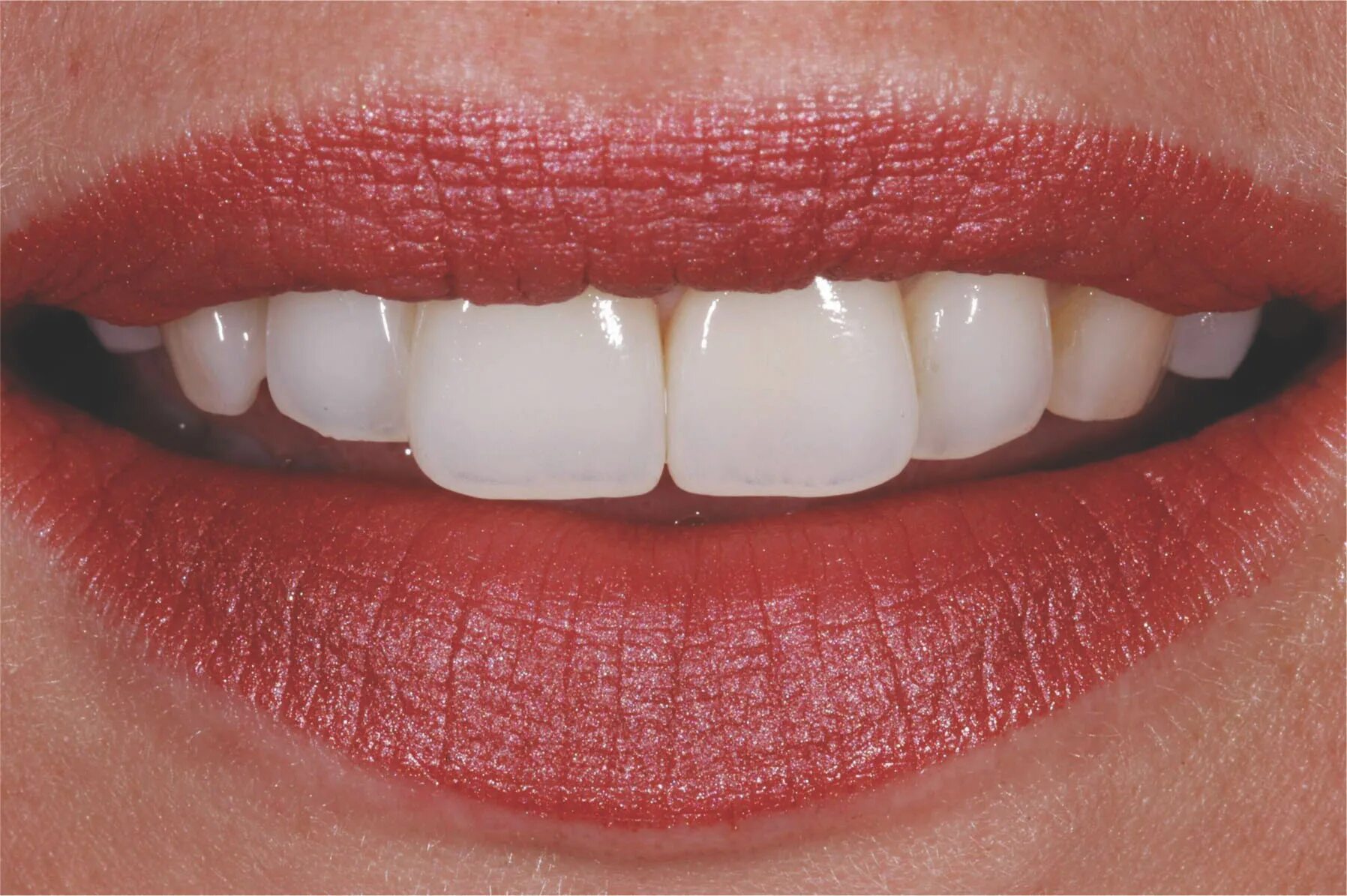 Красивые зубы фото женщины цирконий Implant Dental Laboratory The Art of Aesthetics Digital Lab