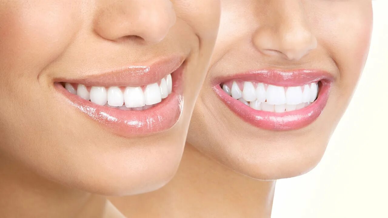 Красивые зубы ул гагарина 20 фото Best Cosmetic Dentist in SHERMAN OAKS (323) 639-4241 Porcelain Veneers - YouTube