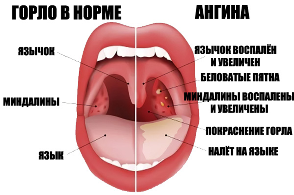Красное горло у взрослого фото как выглядит Летняя ангина у ребенка - в чем причины воспаления и несколько опасна болезнь О 