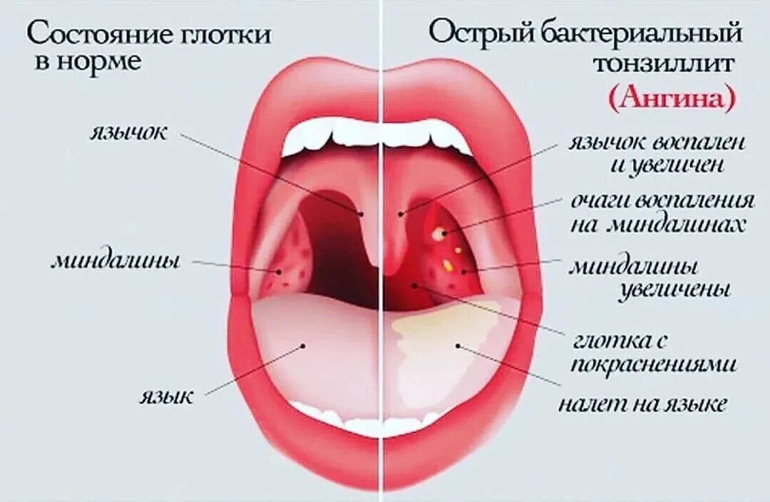 Красное горло у взрослого фото как выглядит Почему может болеть горло? - Медицинский центр "Добрый Доктор"