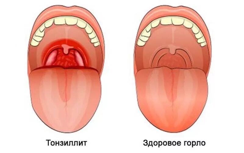 Красное горло у взрослого фото как выглядит Тонзиллит хронический и острый. Симптомы и лечение