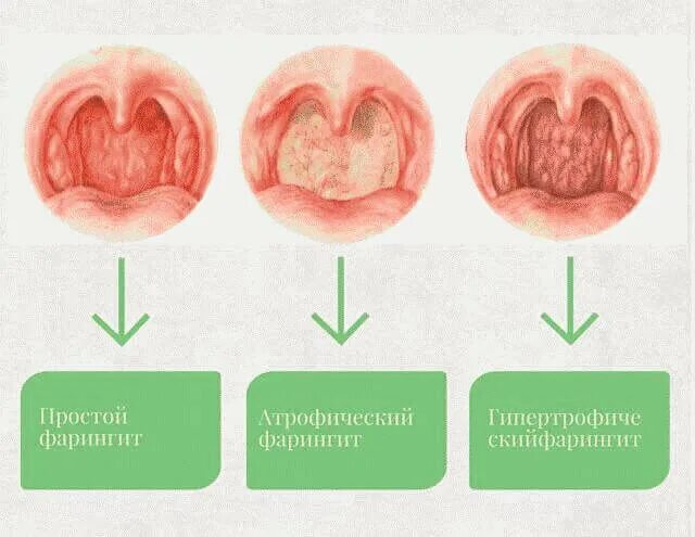 Красное горло в пятнах фото Фарингит острый и хронический у взрослых - о чем нужно знать Наш дом в Новоросси