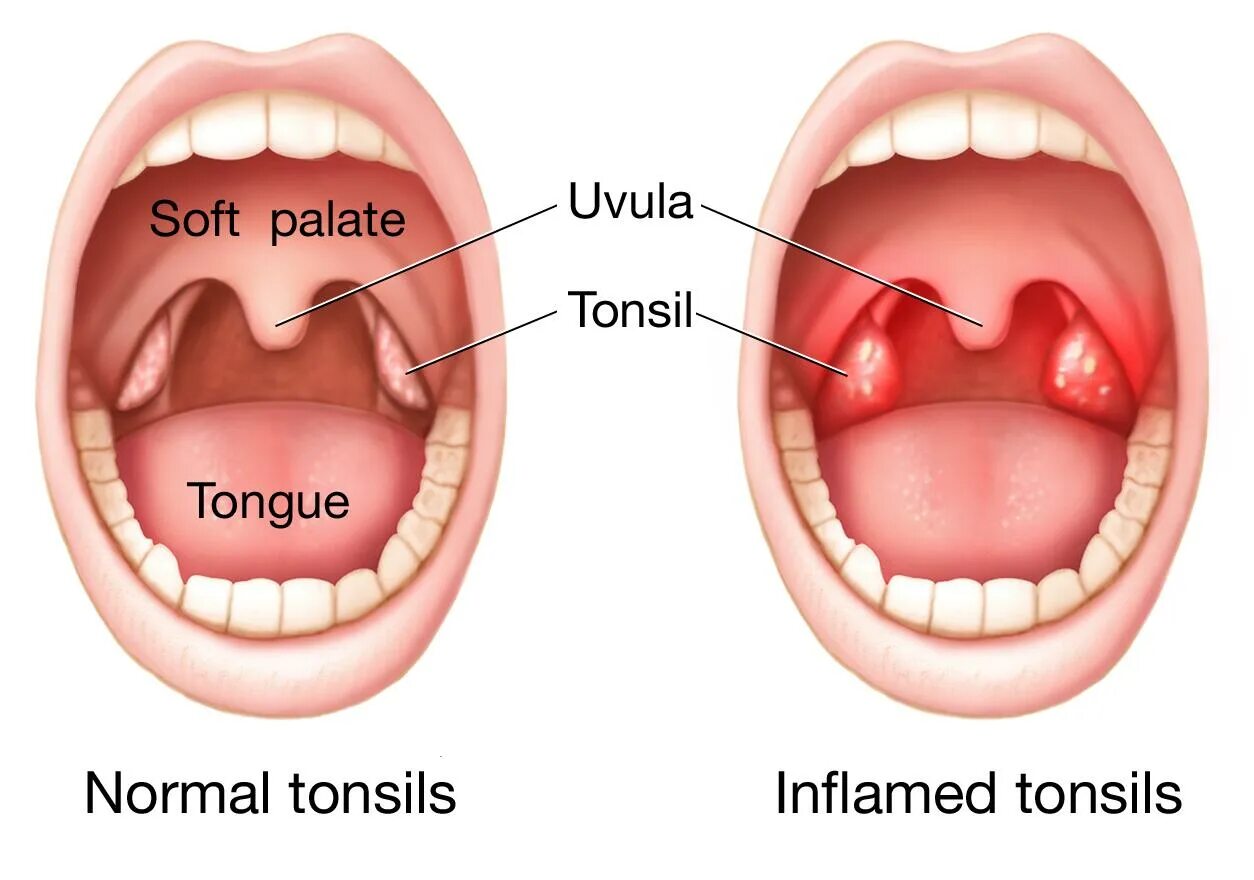 Красное горло живое фото Tonsillitis - Symptoms & causes - Mayo Clinic