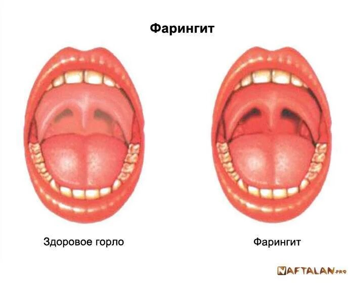 Красное горло живое фото Симптомы катаральной ангины у детей и методы лечения заболевания горла