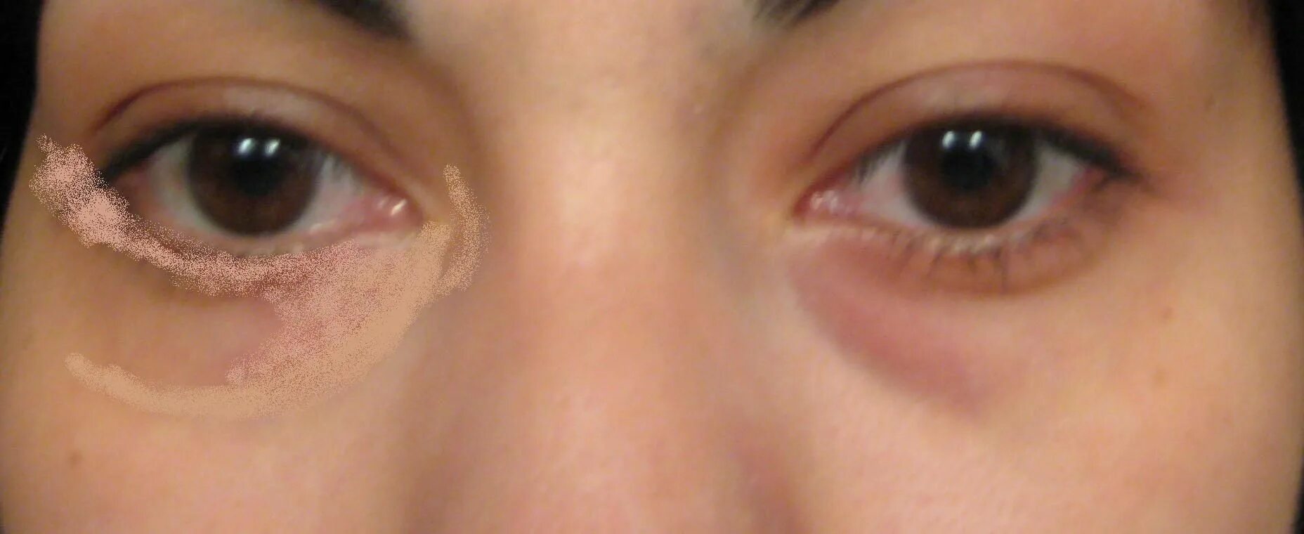 Красное пятно под глазом фото Under-eye Concealer Dark circles under eyes, Dark eye circles, Dark circles