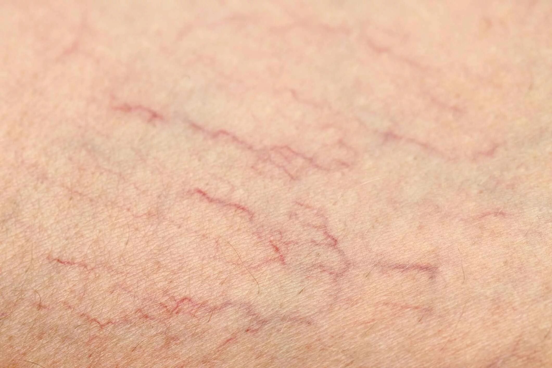 Красное тело у взрослого причина фото Causes and Prevention of Varicose and Spider Veins