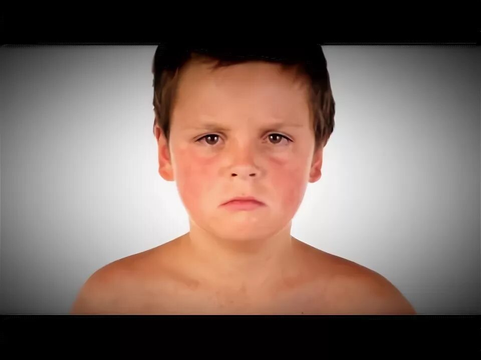 Краснуха фото начальная стадия как выглядит Measles Outbreak in 13 States - YouTube