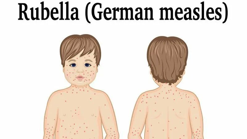 Краснуха фото начальная стадия как выглядит 3 giai đoạn phát triển của rubella Vinmec