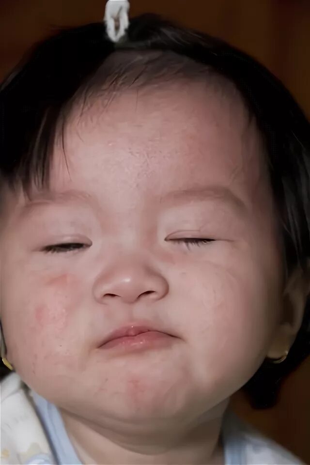 Краснуха фото начальная стадия как выглядит Symptoms of Rubella in Children Pictures - 23 Photos & Images / illnessee.com