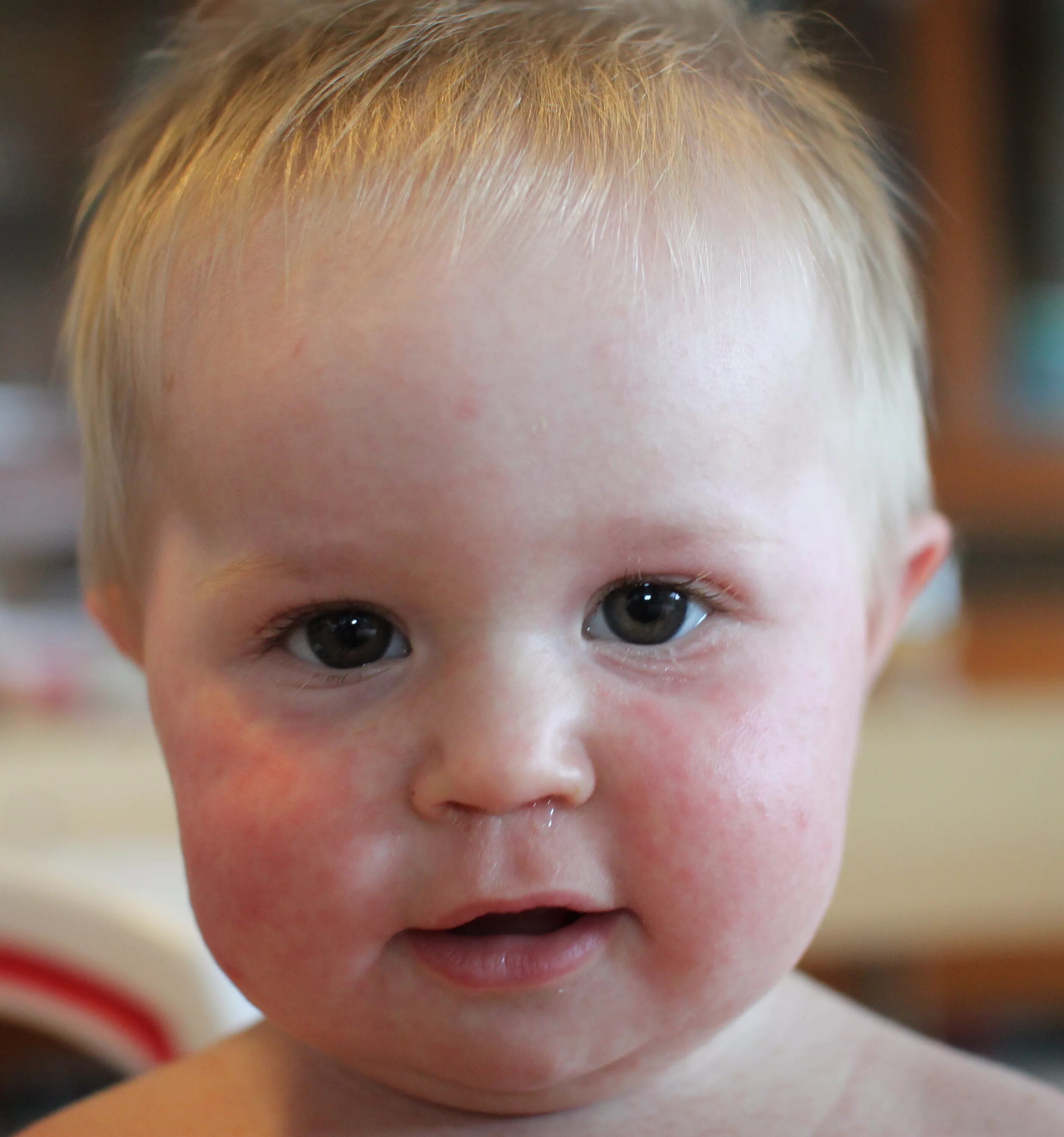Краснуха фото начальной стадии Can Roseola Be Only On Face Arms Legs on Sale bellady.by