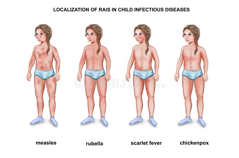 Краснуха фото сыпи у детей Localization of Rash in Child Infectious Diseases Stock Illustration - Illustrat