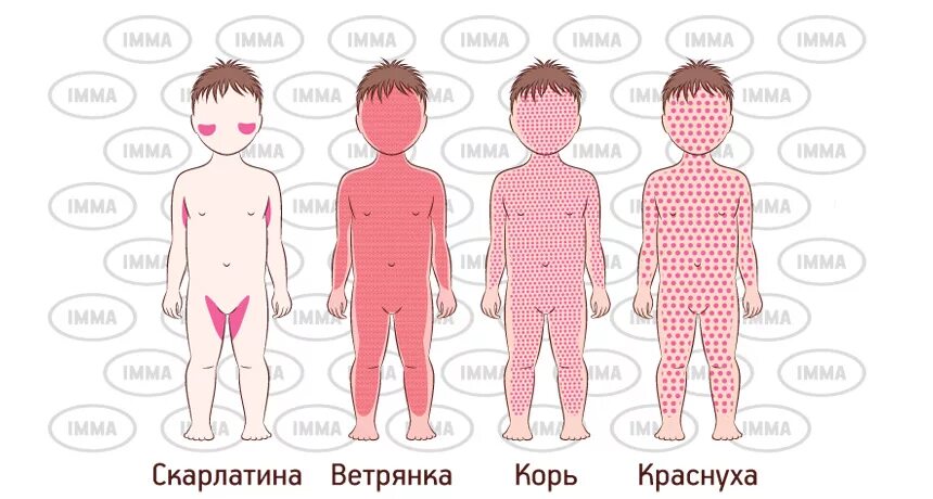 Краснуха фото сыпи у детей 7 лет Детские инфекции - сеть клиник IMMA