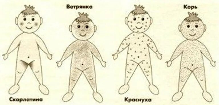 Краснуха какая сыпь фото Diagnosis and treatment of measles. Photo
