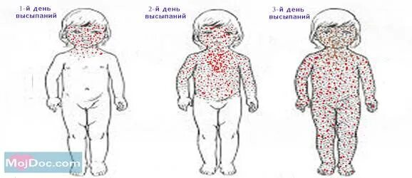 Краснуха какая сыпь фото Может ли ветрянка у детей протекать без температуры и при небольшом количестве в