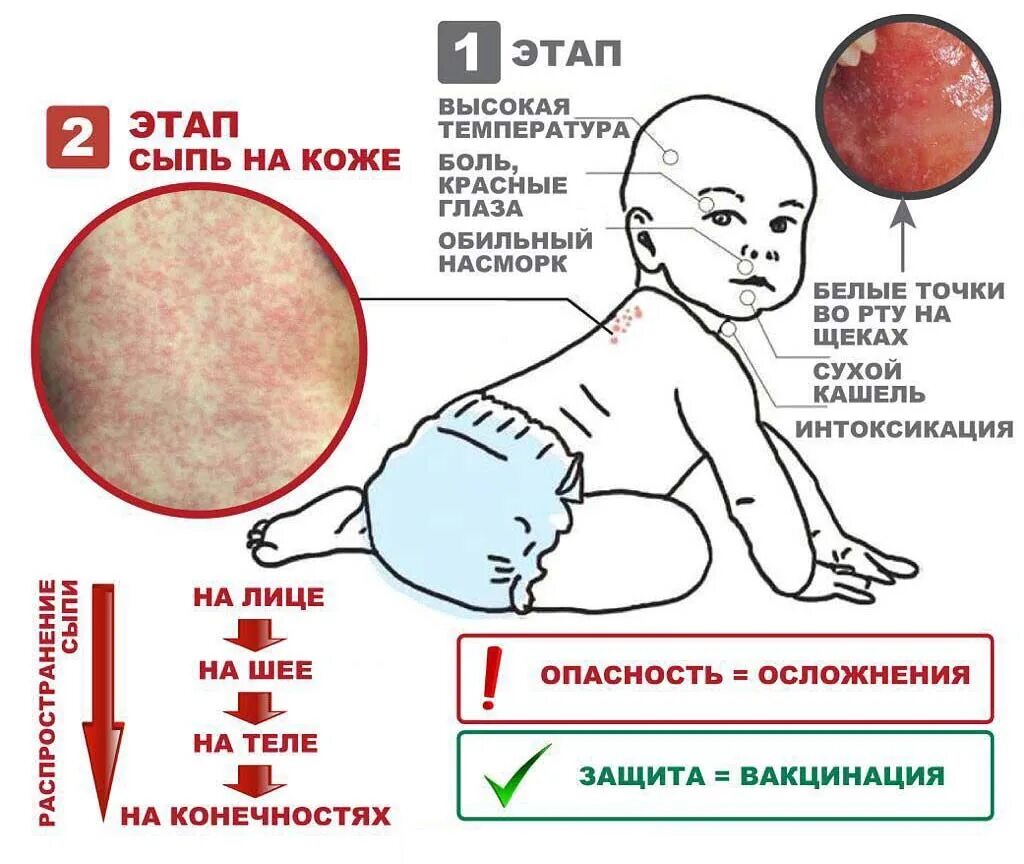 Краснуха симптомы у взрослых фото и лечение Корь Официальный сайт органов местного самоуправления Труновского муниципального