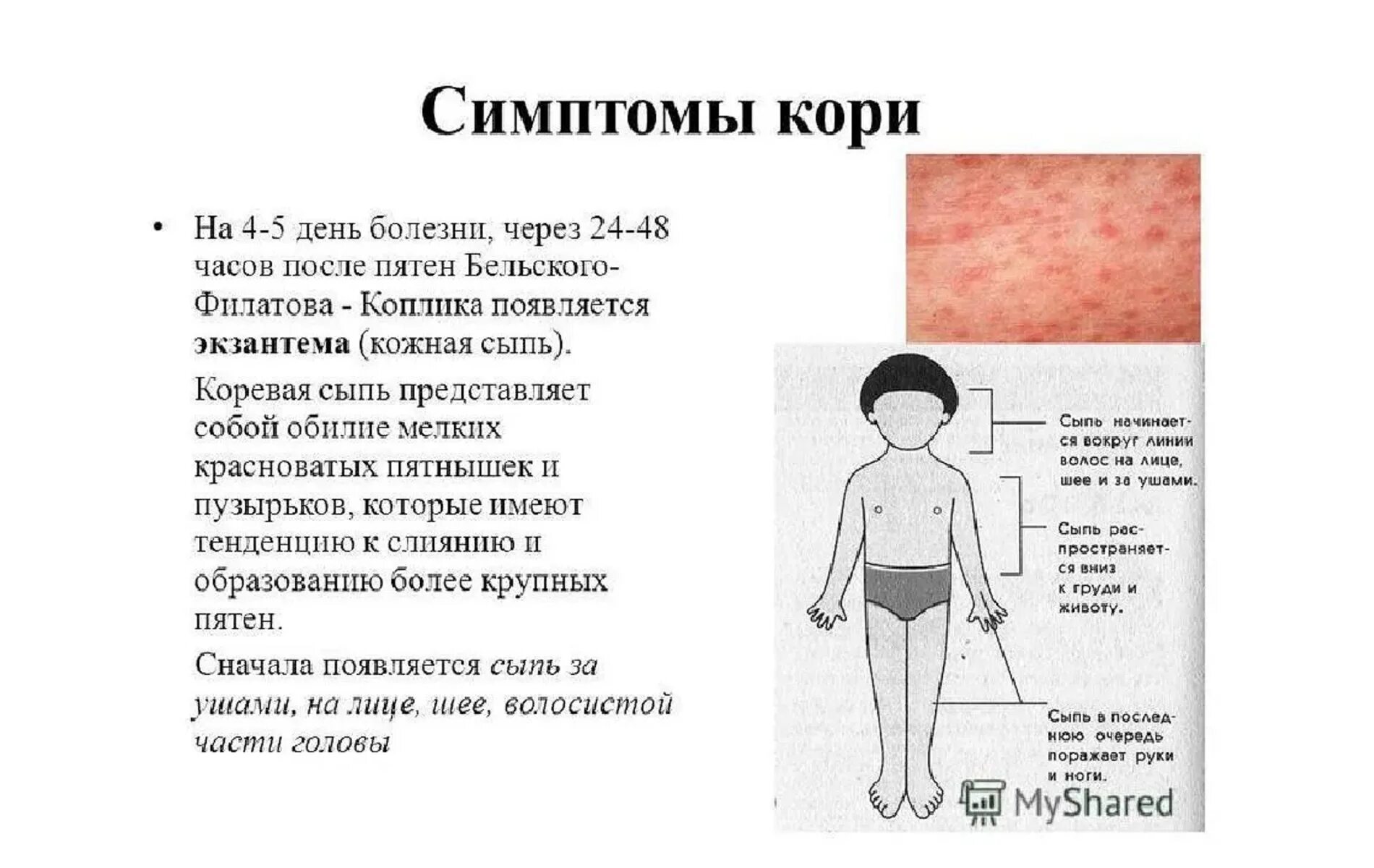 Краснуха сыпь у детей фото реальные Сыпь у ребенка виды болезней - найдено 89 картинок
