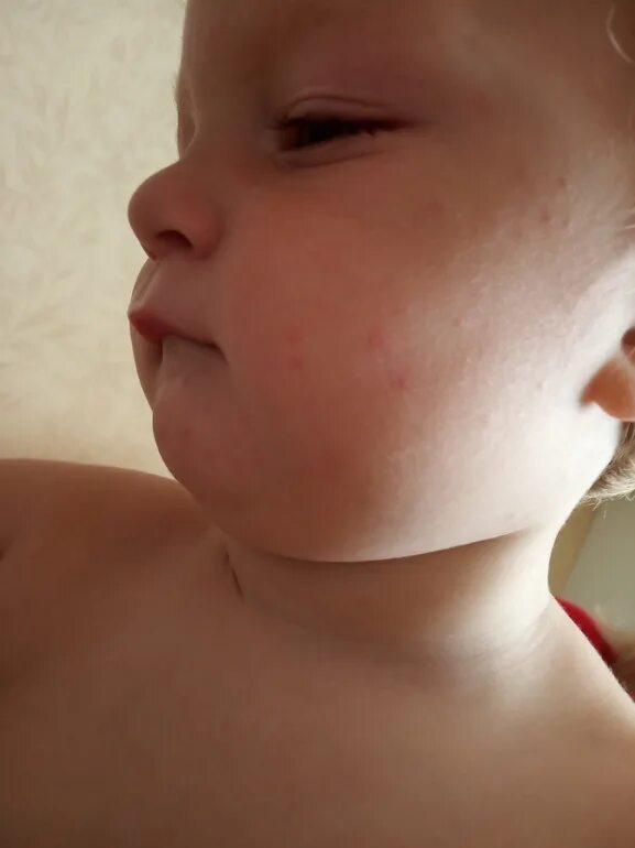Краснуха сыпь у детей фото реальные Сыпь - 8 ответов форум Babyblog
