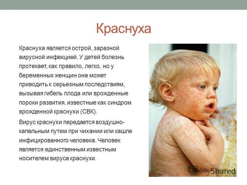 Краснуха сыпь у детей фото реальные Краснуха - острое инфекционное заболевание, передающееся воздушно-капельным путе