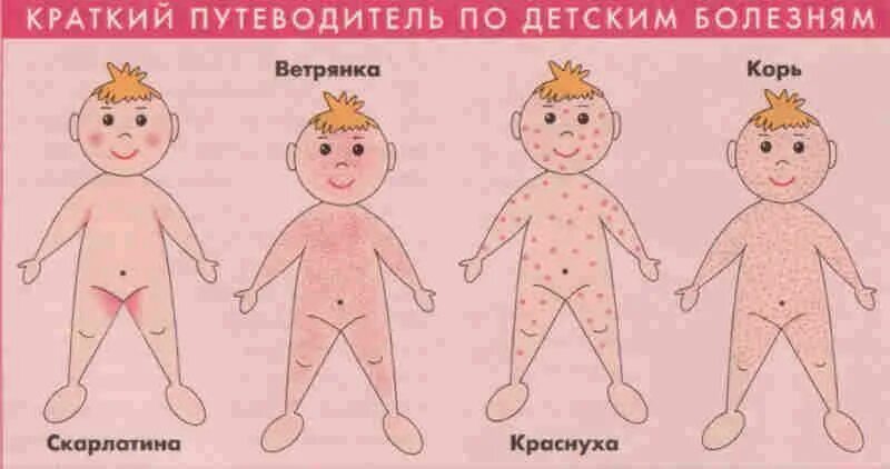 Краснуха сыпь у детей фото реальные симптомы Грузія не братиме участі в навчаннях НАТО через вірус " МІА Вектор Ньюз