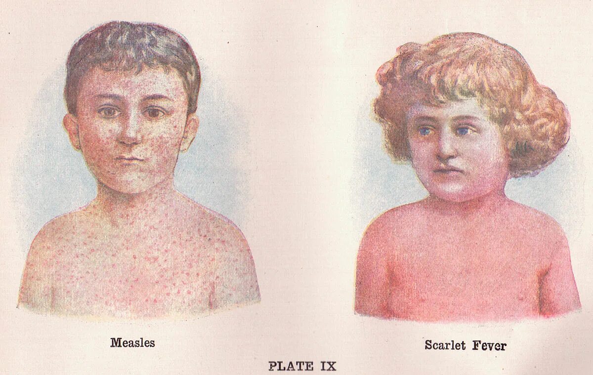 Краснуха у детей фото начальной стадии Exanthème scarlatiniforme - Wikipédia