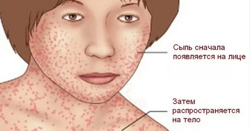 Краснуха у взрослых фото сыпи лечение В Башкирии раскрыли данные по распространенности инфекции, считавшейся побежденн