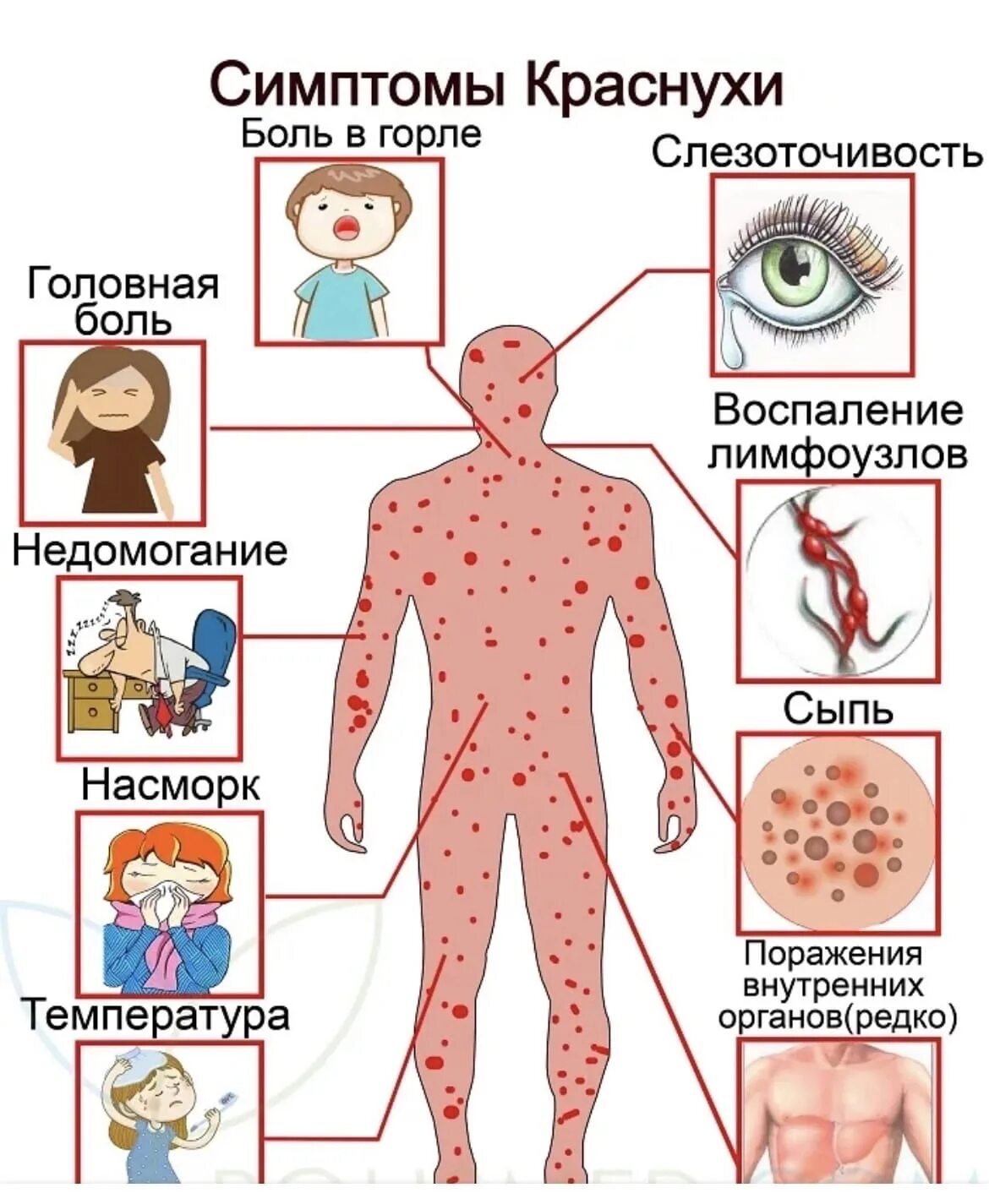 Краснуха у взрослых стадии фото Краснуха - симптомы и лечение - РКЦИБ Грозный