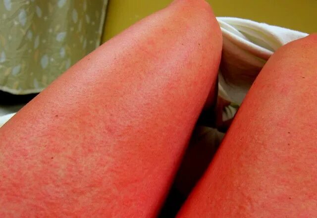 Красную у взрослых фото An Allergic Reaction - Peanut Butter Fingers