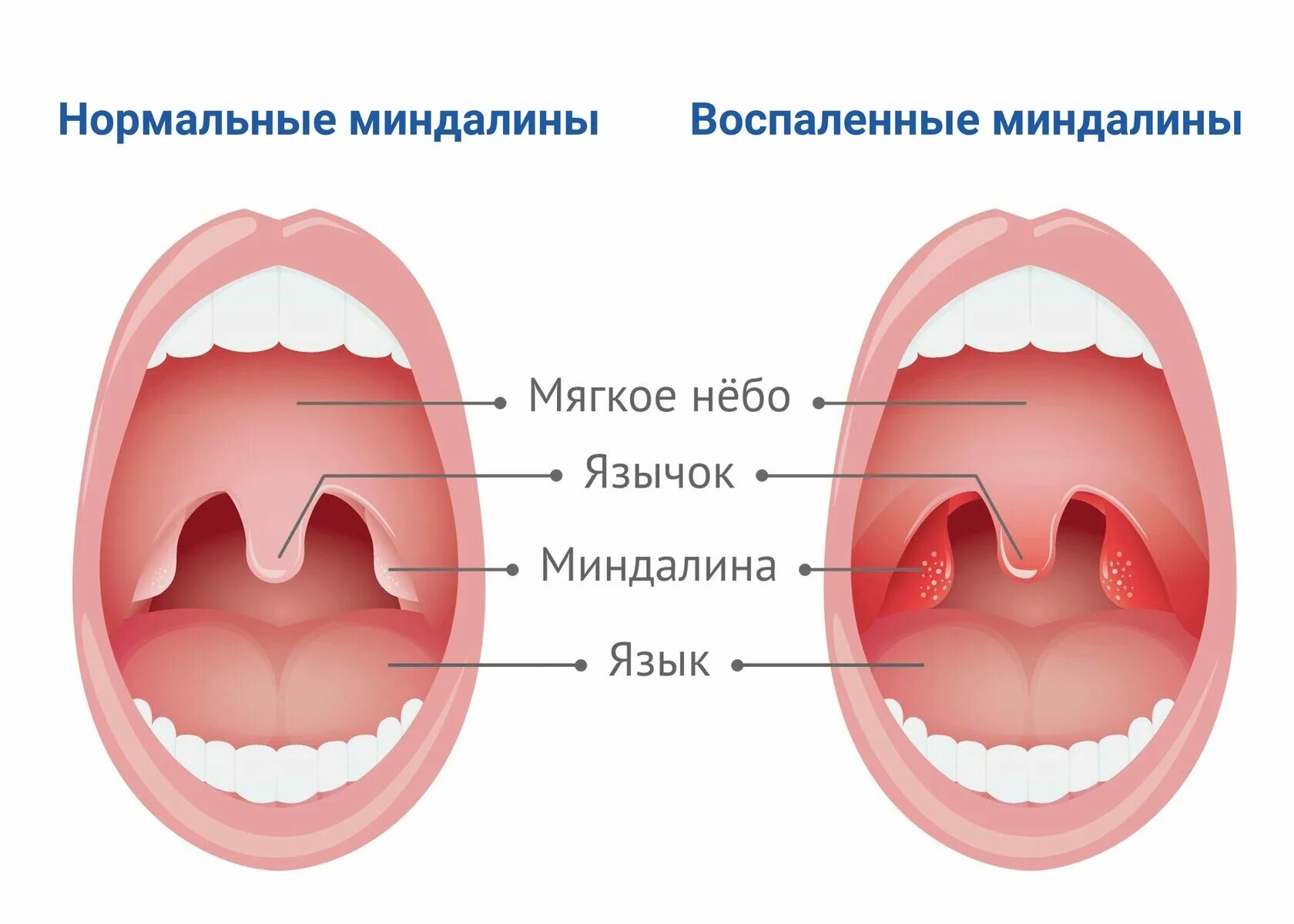 Красные дужки в горле у ребенка фото Лакунотомия