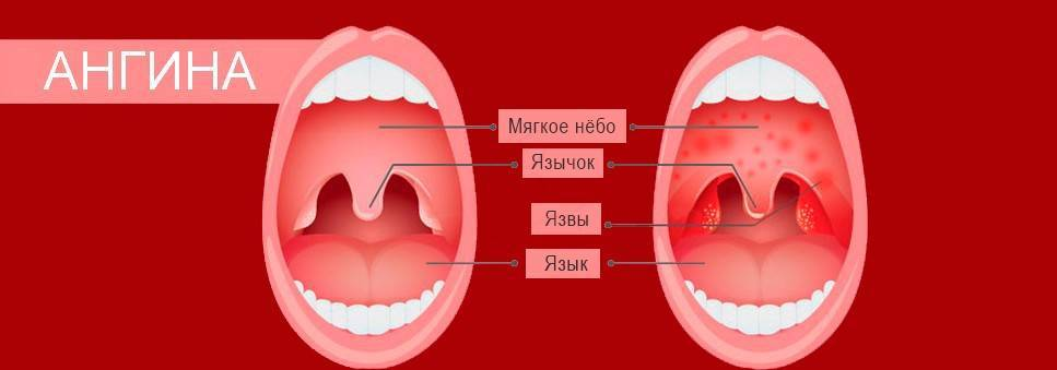 Красные дужки в горле у ребенка фото Летняя ангина у ребенка - в чем причины воспаления и несколько опасна болезнь О 