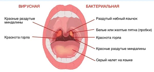 Красные дужки в горле у ребенка фото Вирусная ангина: симптомы и признаки, как выглядит горло, как отличить от бактер