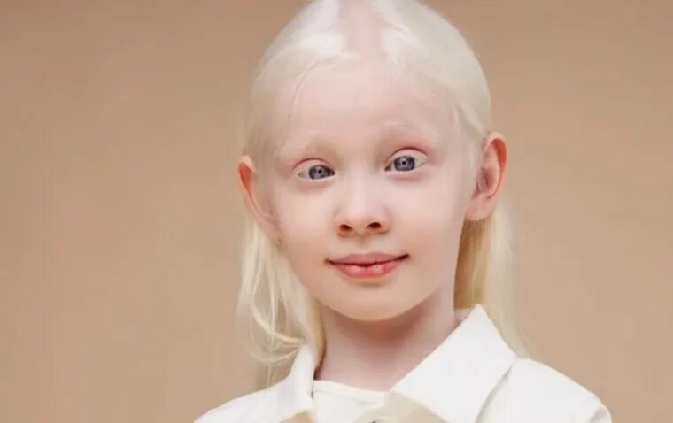 Красные глаза альбиносов фото Study Reveals Why People with Albinism Have Poor Vision OBN