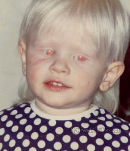 Красные глаза альбиносов фото Albinism at emaze Presentation