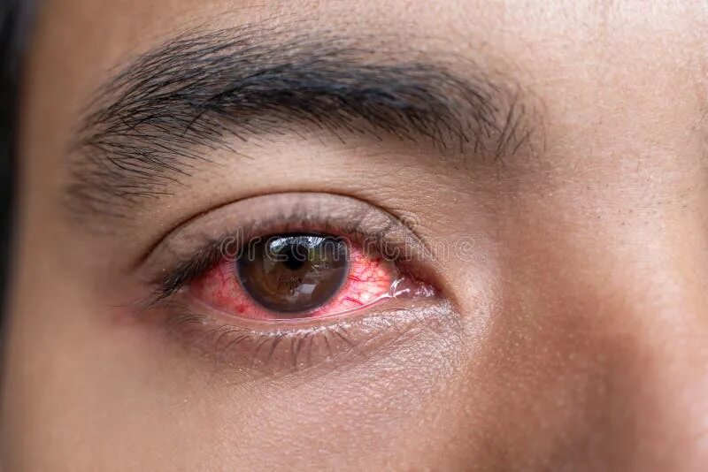 Красные глаза фото онлайн Close Up of Man Red Irritated Eyes Stock Image - Image of male, illness: 1380512