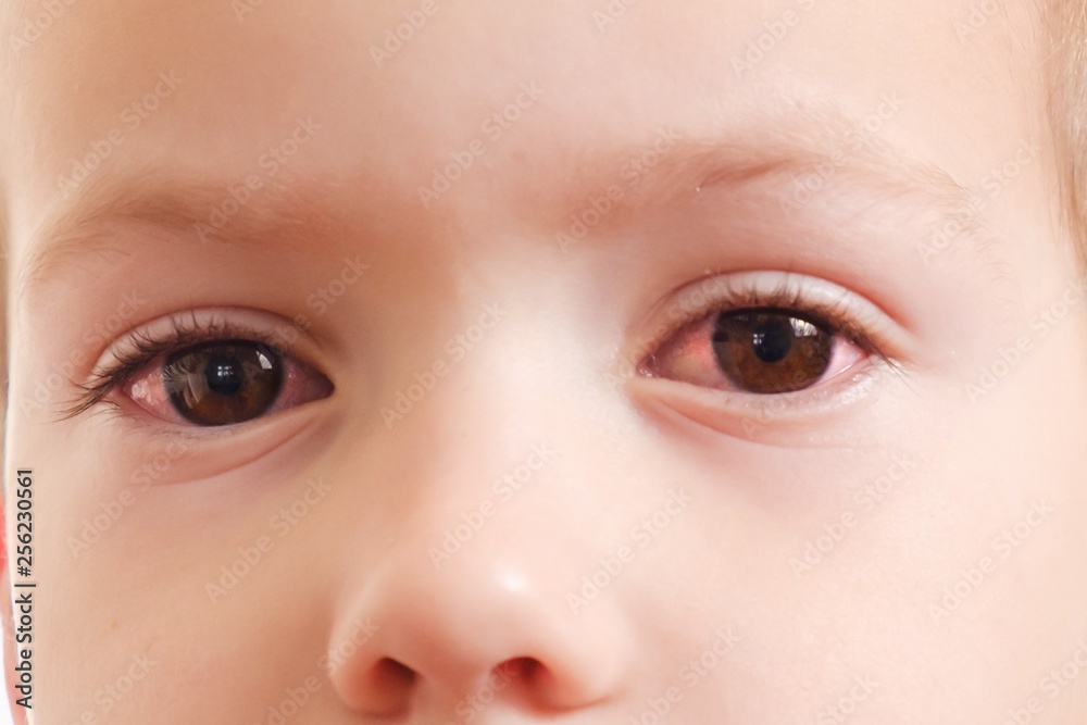 Красные глаза у детей фото Child conjunctivitis red eye with infection, health. фотография Stock Adobe Stoc
