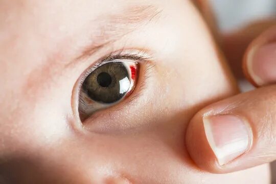 Красные глаза у детей фото Derrame En El Ojo Изображения: просматривайте стоковые фотографии, векторные изо
