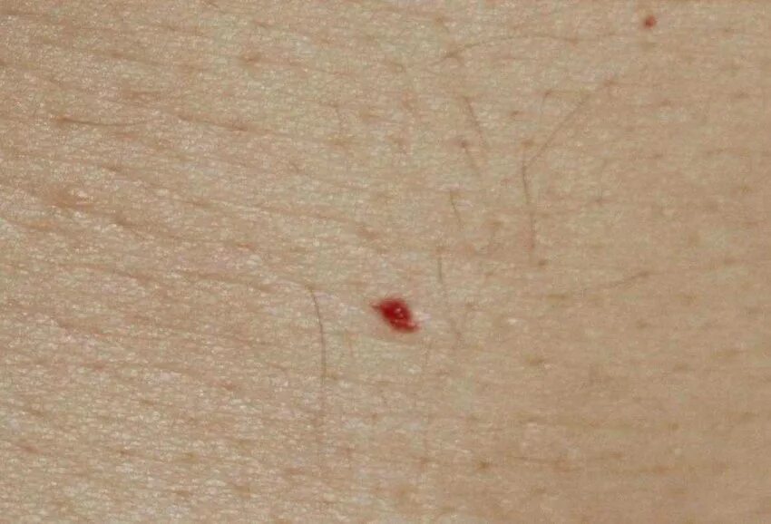 Красные кровяные точки на теле фото De Morgan's sign OBJAW DE MORGANA (cherry angioma, senile angiomas).... Download