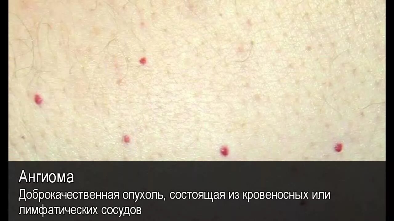 Красные кровяные точки на теле фото Ангиома. Толковый Видеословарь русского языка - YouTube