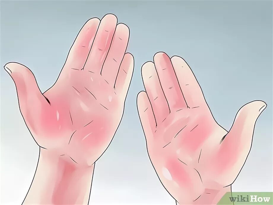 Красные ладони при болезни печени фото Comment savoir si l'on a une cirrhose: 15 étapes