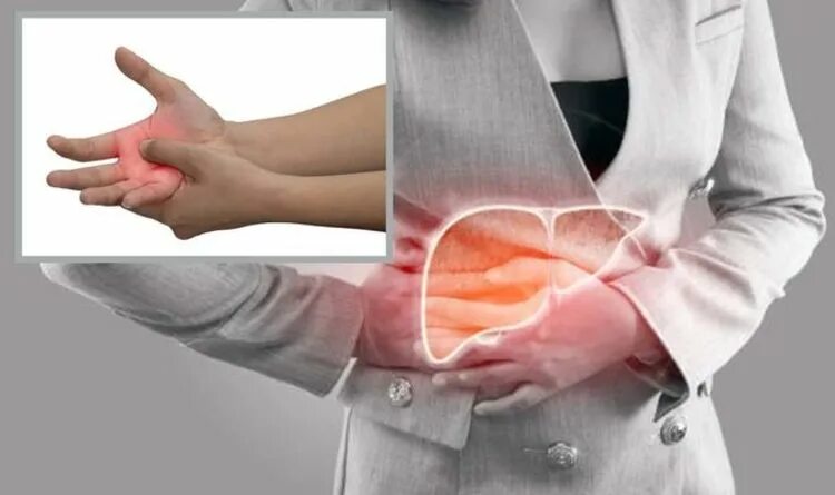 Красные ладони при болезни печени фото Fatty liver disease: Signs include red palms and nail beds turning white Express