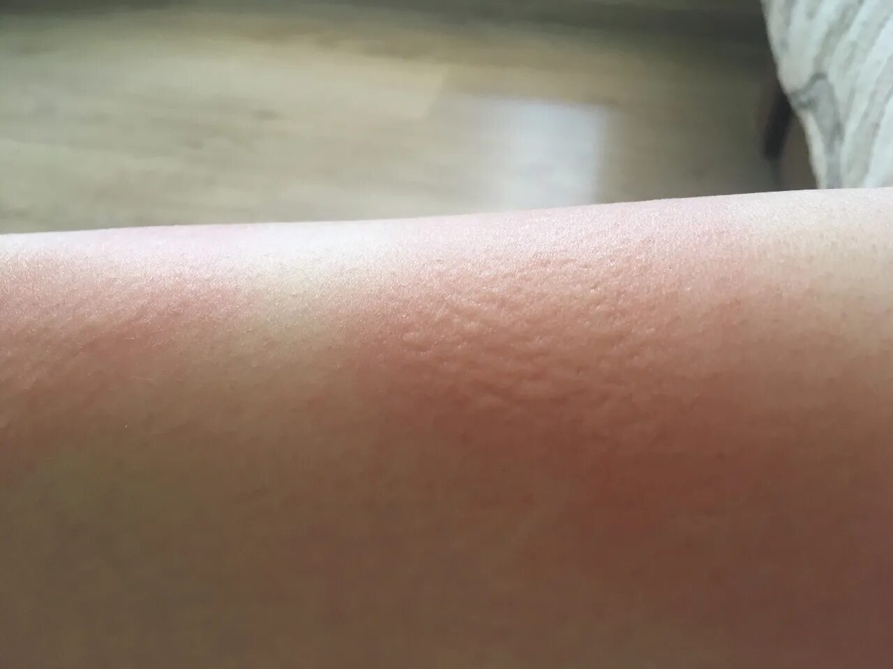 Красные пятна фото и описание Красные пЯтна на ногах появляются и пропадают - Вопрос дерматологу - 03 Онлайн