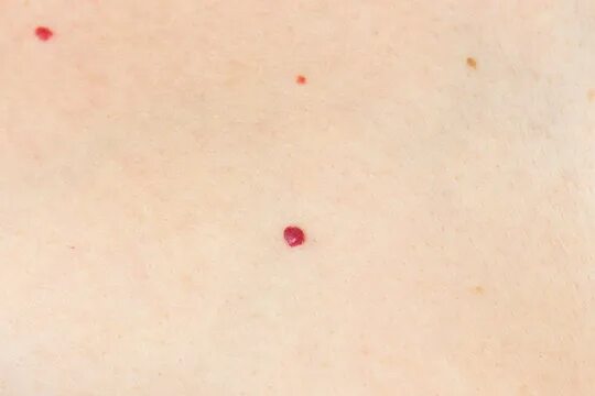 Красные пятна фото и описание Angioma Зображення - огляд 463 Стокові фото, векторні зображення й відео Adobe S