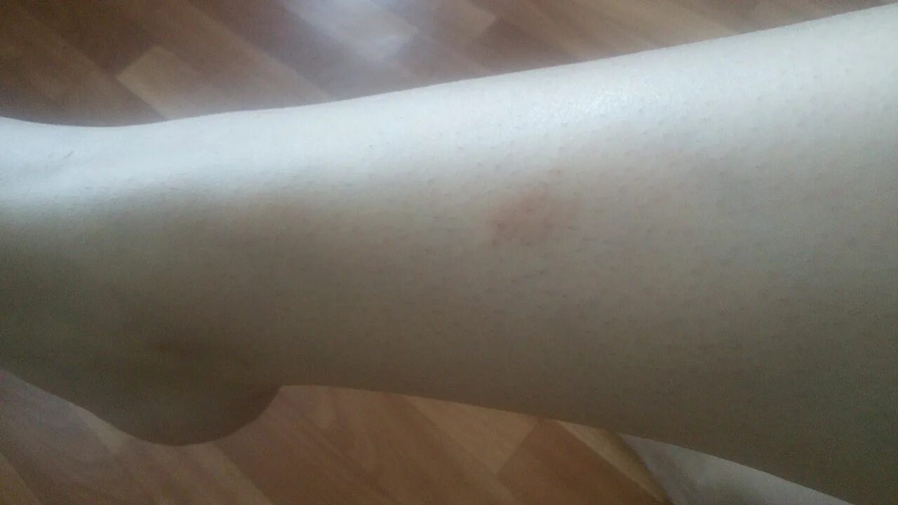 Красные пятна фото причины у женщин Пятна на теле похожие на засосы, держатся около 10 дней - Вопрос дерматологу - 0