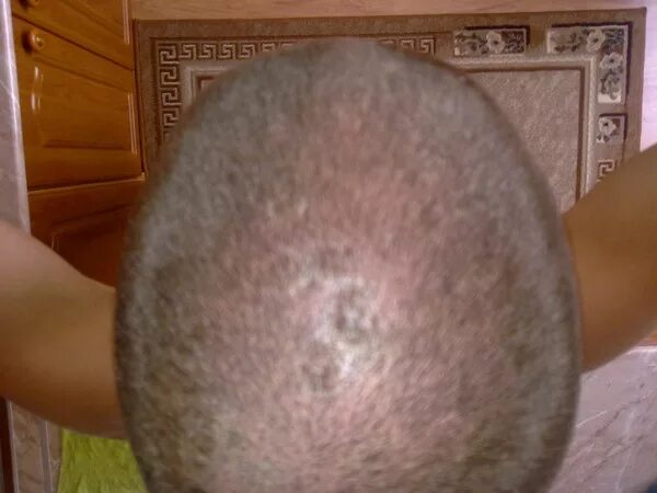 Красные пятна на головке у мужчин фото Ответы Mail.ru: Болячки на голове в совокупностью с перхотью!