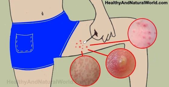 Красные пятна на головке у мужчин фото Effective Ways to Get Rid of Bumps on Inner Thigh (Backed by Science)